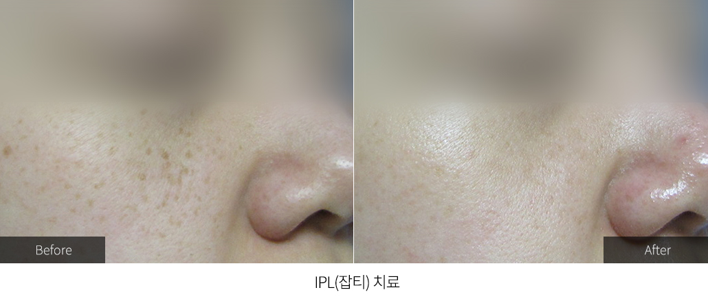 IPL(잡티) 치료