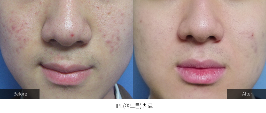 IPL(여드름) 치료