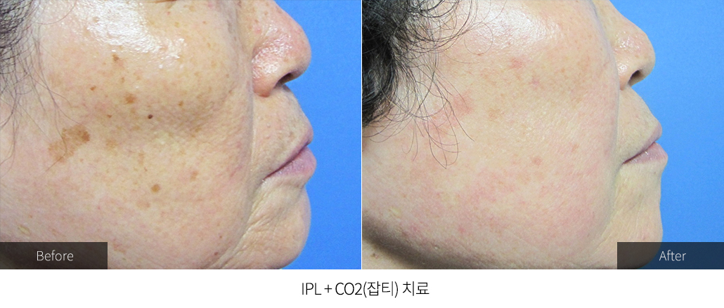 IPL + CO2(잡티) 치료